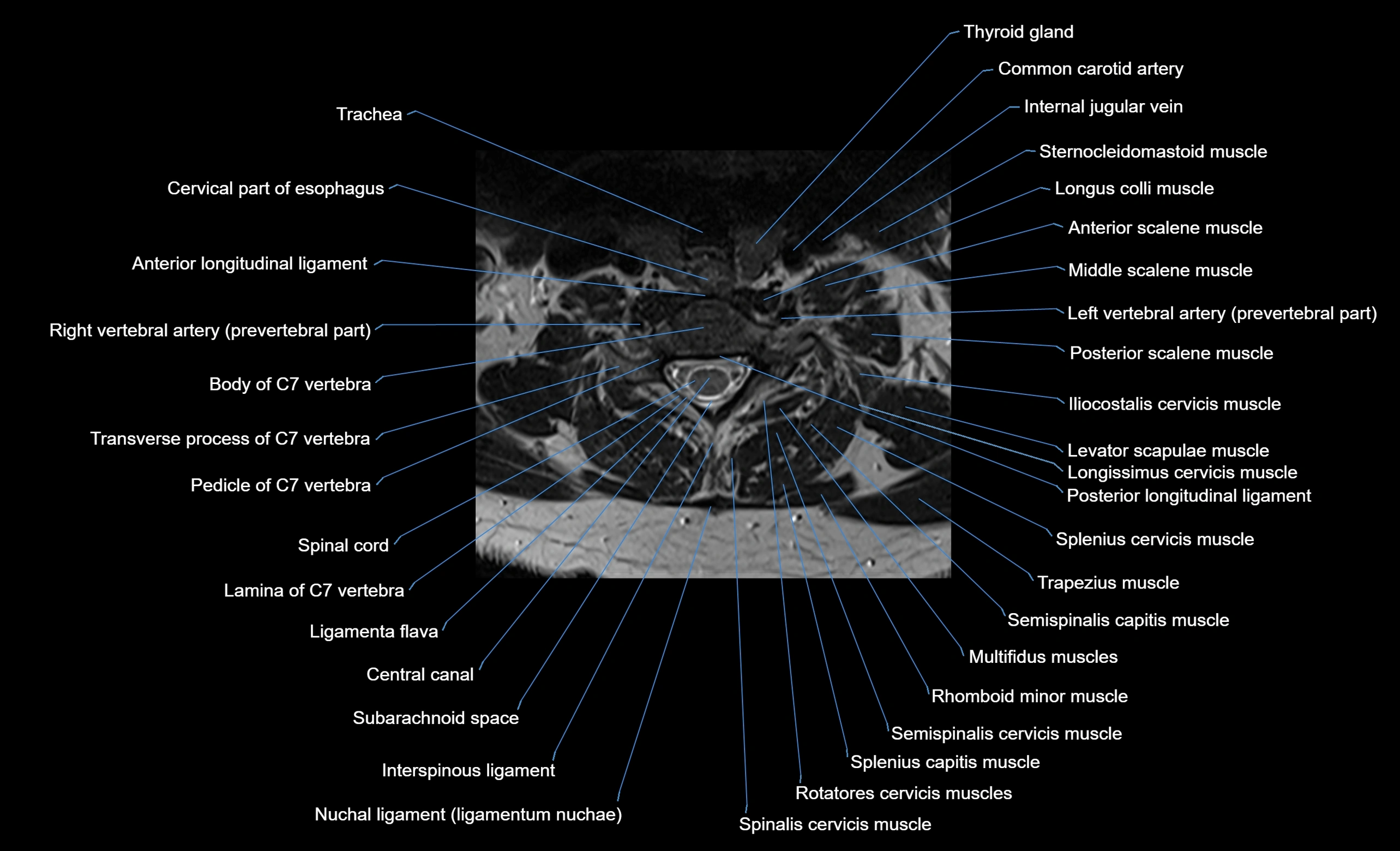 cervical spine cross sectional MRI anatomy  3T MRI axial  image-img-00001-00035.webp